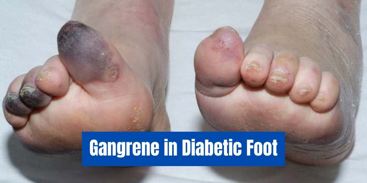 gangrene in diabtic foot